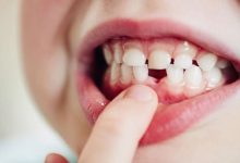 تفسير حلم سقوط الاسنان