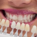 تفسير حلم تركيب طقم اسنان للميت