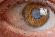 اكثر امراض العيون انتشارا : الدليل النهائي
